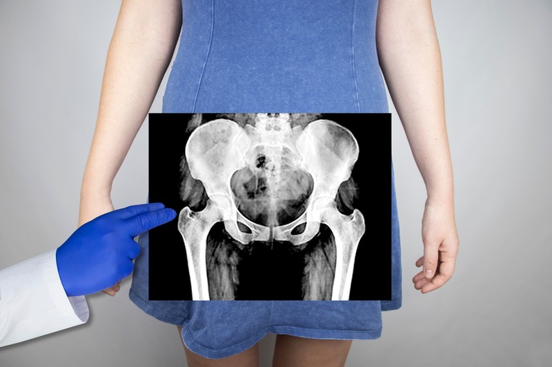 Kalcium-foszfát: a csontoknak előnyös, de ha így szedi, már veszélyes