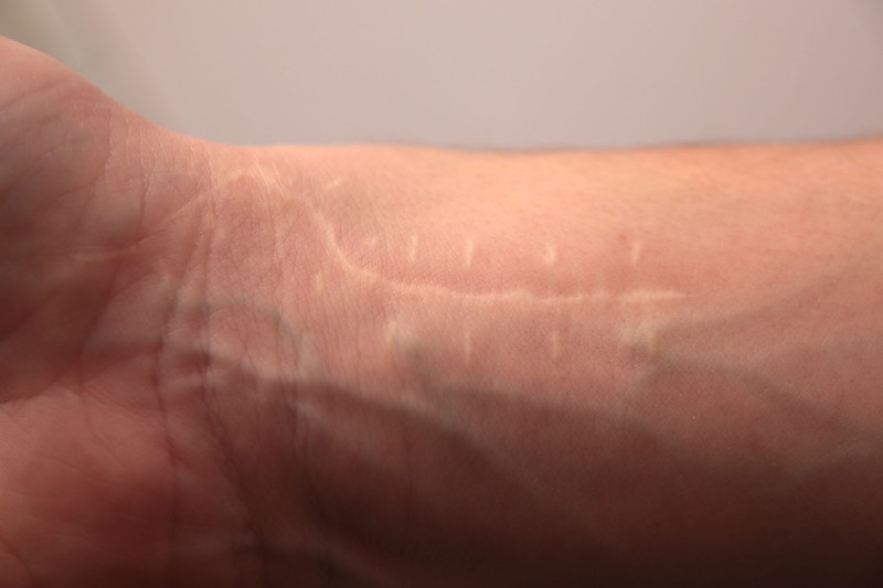 Meglepő, de a seb nem felejt! Egy régi heg is okozhat derékfájást, székrekedést, vagy akár meddőséget