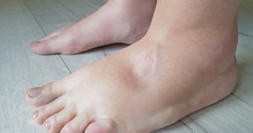  Ödémás láb: innen tudhatja, hogy szívprobléma okozza 