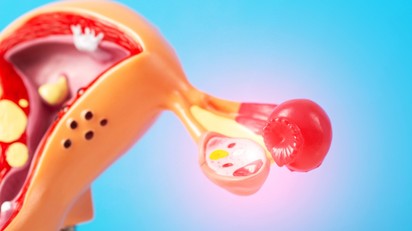 Petefészekrák: tünetei, kivizsgálása és kezelési lehetőségei című cikk nyitóképe