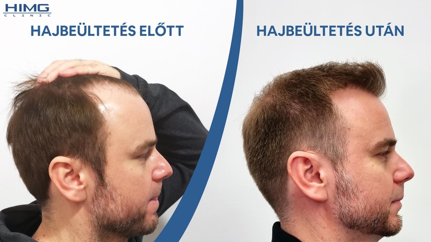 A 3+2 leggyakoribb hajbeültetési terület a fejen