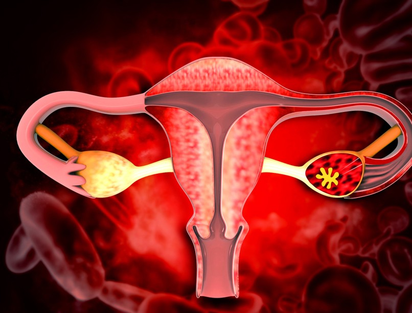 mióma, daganat, ciszta, d-vitamin