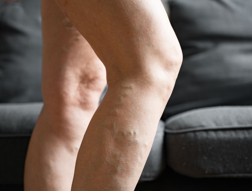 visszér, fájdalom, kezelés otthon