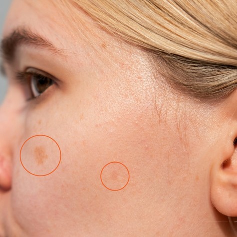 Miért jelenhetnek meg idő előtt az öregségi foltok, és mit kezdhetünk velük? című cikk nyitóképe