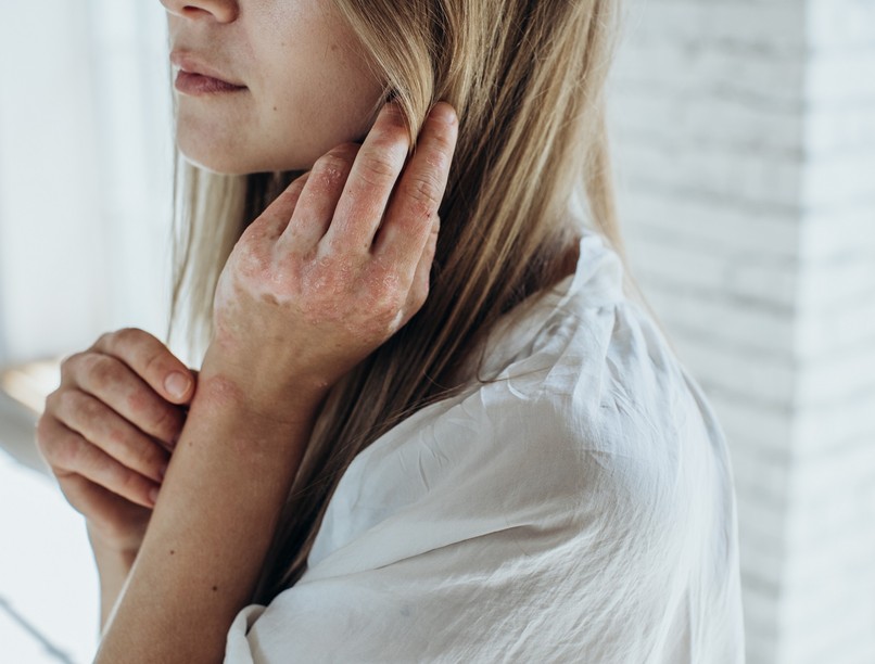 Ekcéma vagy pikkelysömör különbség