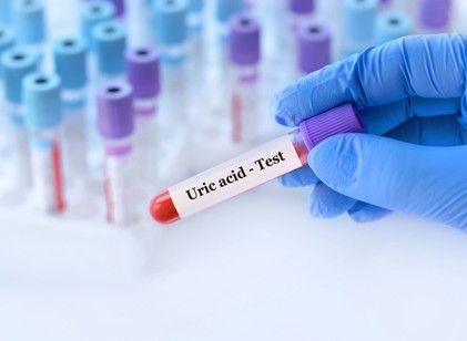 Öt egyszerű módszer a magas húgysavszint mérséklésére: így védheti meg az ízületeit és a veséjét című cikk nyitóképe