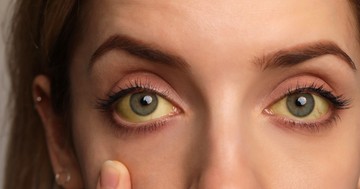  Kezeletlen, szövődményes epekő: így árulja el a szemünk az epebetegséget 