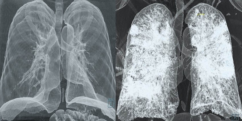 Balra: egészséges tüdő, CT-vizsgálattal rögzítve; helyesen: COVID-19-cel fertőzött személy tüdeje.