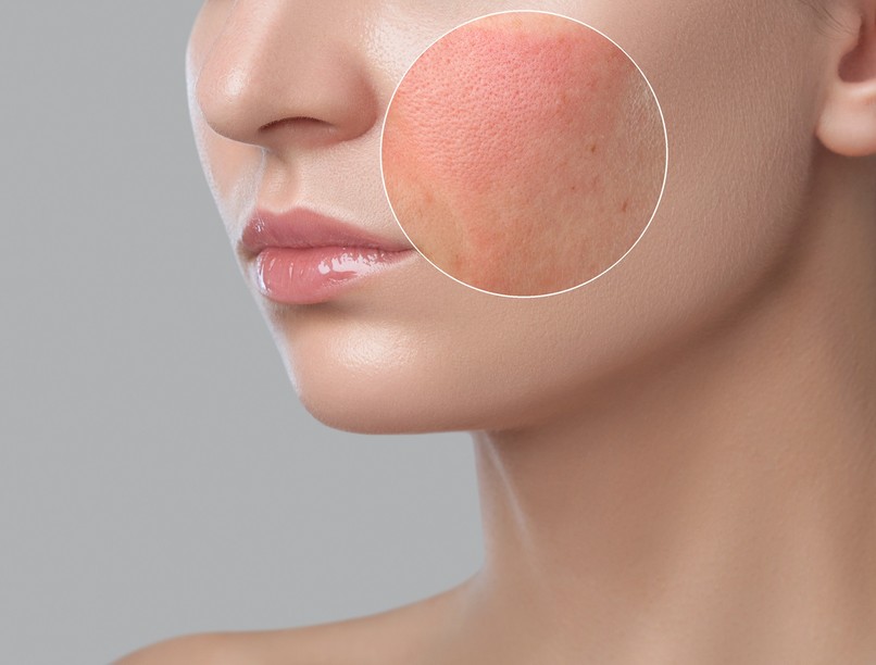 lupusz jele autoimmun betegség tünet arc