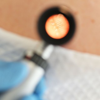 Ezért fontos télen ellenőrizni magunkon az anyajegyeket: 5 jel, ami melanómára utalhat című cikk nyitóképe