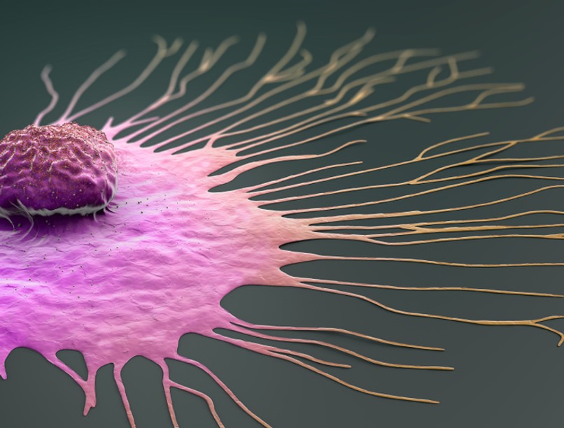 ciszta, mellrák, melldaganat, mellrák tünetei, ciszta tünetei, mellrák, emlőrák, emlődaganat, gyulladásos mellrák, tünetei, kezelése