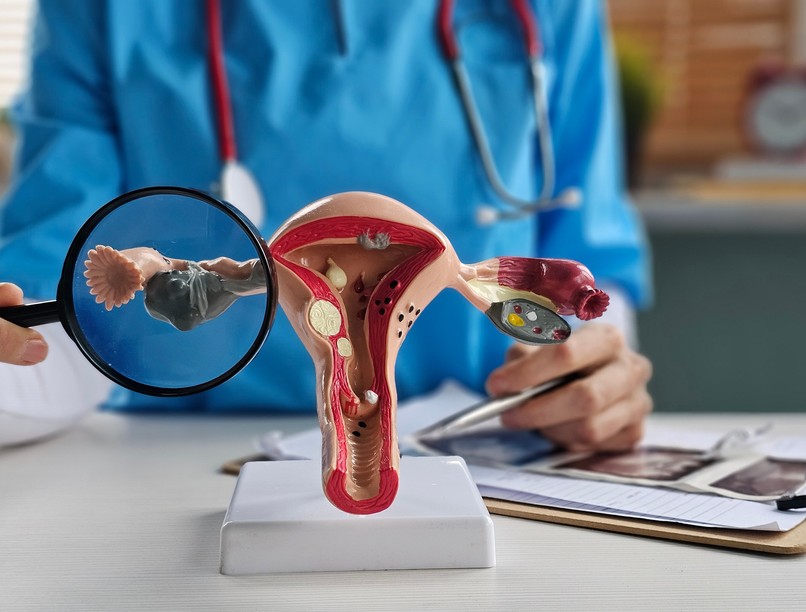 PCOS-vizsgálat lépésről lépésre