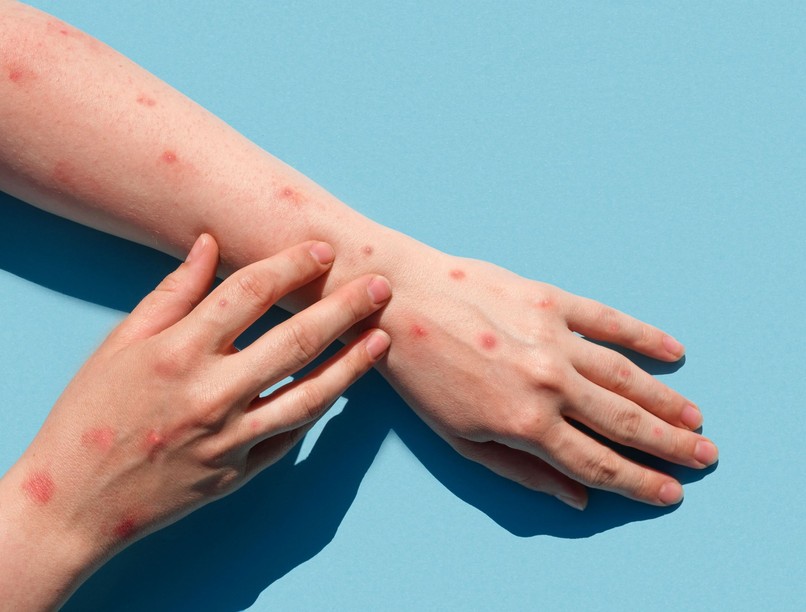 alaszkai himlő vírus alaskapox betegség tünet