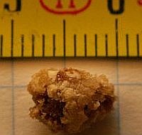 C-vitamintól - a vesekőképződésig?