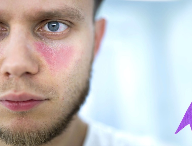 lupus első korai jelei