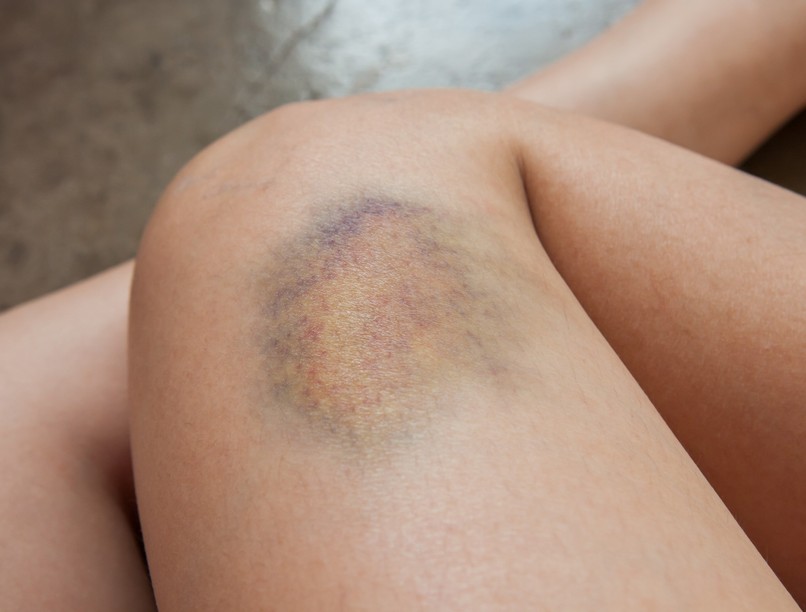 kék-zöld foltok bőrön véralvadásgátló gyógyszer mellékhatása