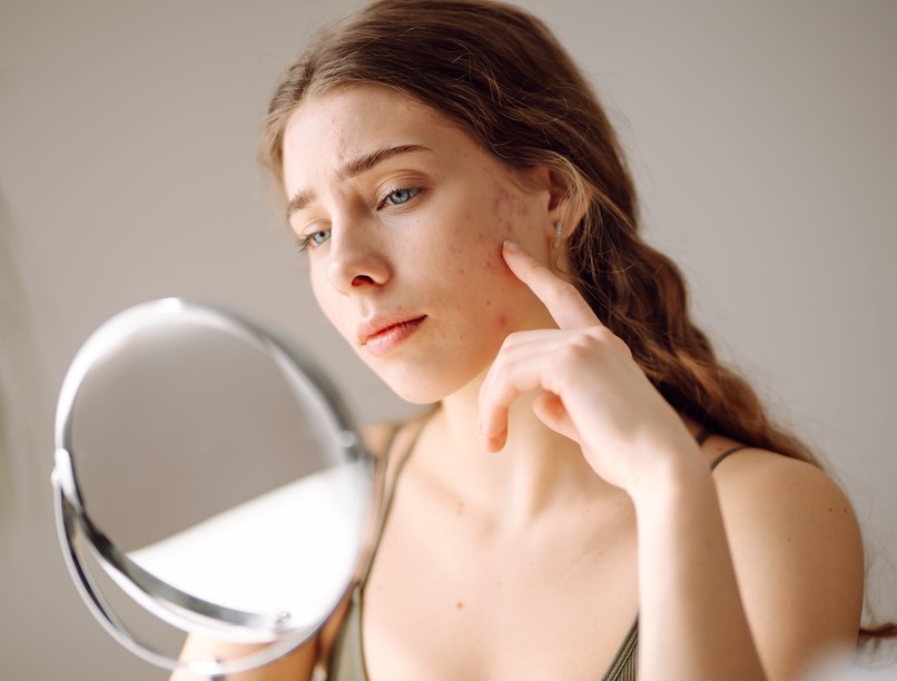 mi az akne pattanás tünet ok kezelés