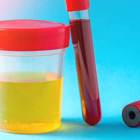 Öt módszer a magas húgysavszint csökkentésére című cikk nyitóképe