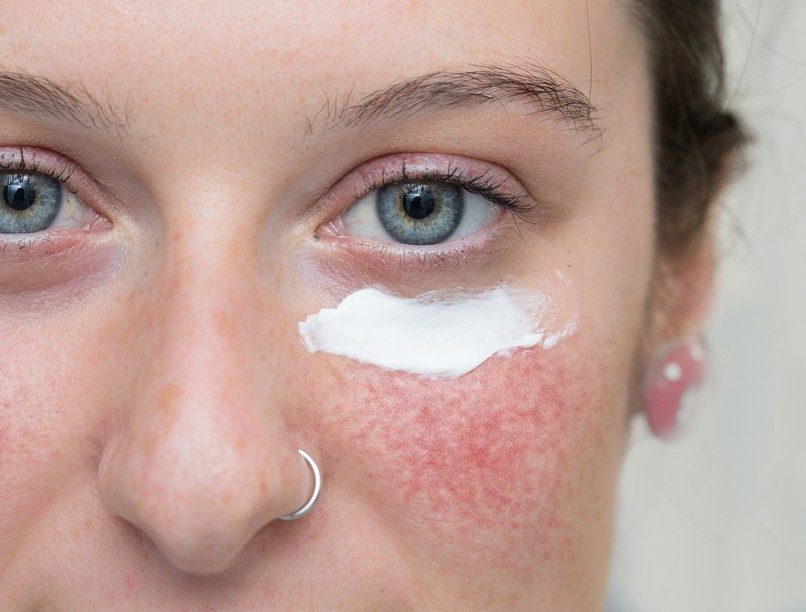 rosacea bőrpír ellen nyáron uv sugárzás