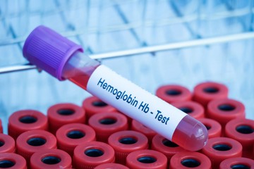 Alacsony hemoglobinszint  - ebben az esetben már igen veszélyes
