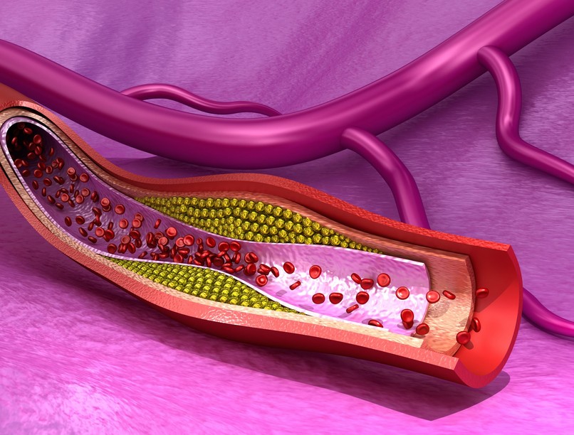 életveszélyes artériás trombózis stroke tünete