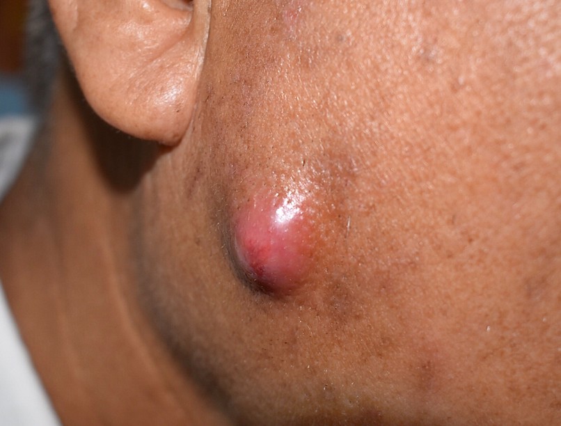 Mire utal kelés a bőrön