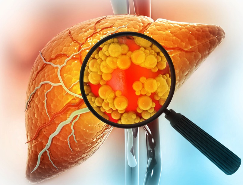 zsírmája oka, jele, májkárosodás tünete