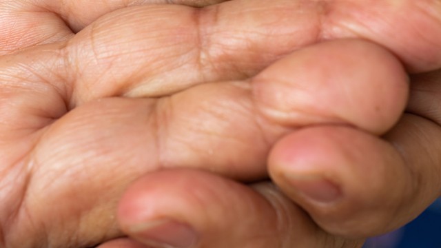 Mit tegyünk, ha a mamának eltűnt az ujjlenyomata? Vakcinainfó - Az orvos válaszol