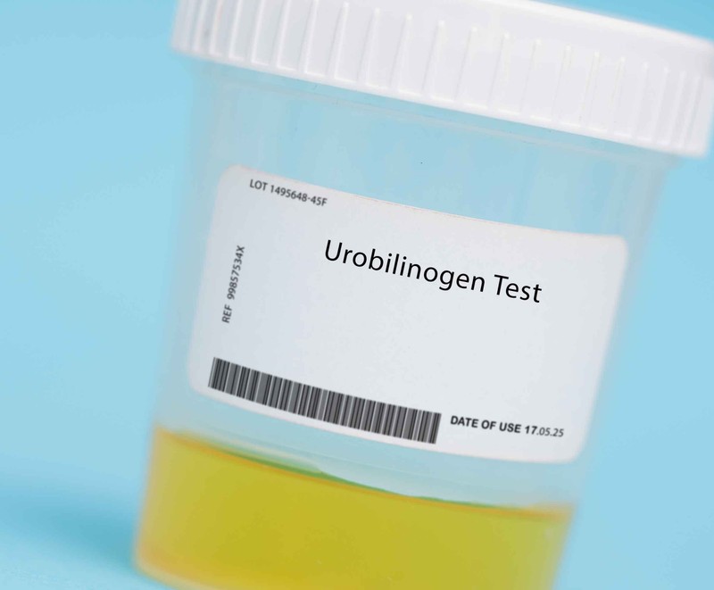 Mit jelent az urobilinogén (UBG) érték a laborleleten?