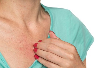 Viszkető kiütések nyáron? Ezektől a gyógyszerektől is lehet!