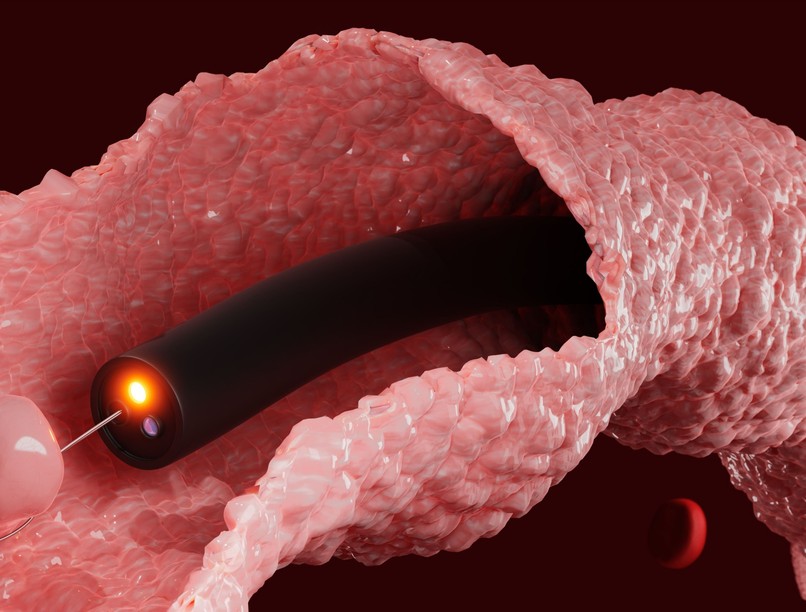 mikor kell kolonoszkópiára menni