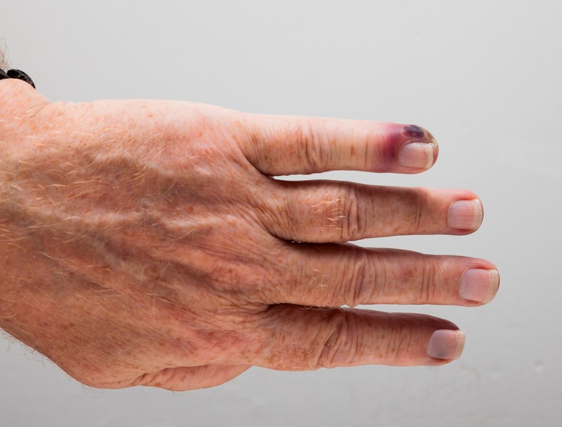 vérmérgezés szepszis tünete piros csík halad szív felé