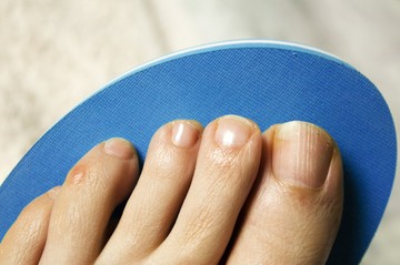 Otthoni gyógymódok körömgomba ellen? Ezeket próbálja ki!