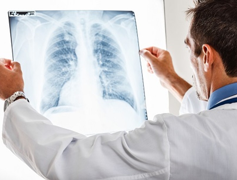 tüdőrák, daganat, rák, férfiak