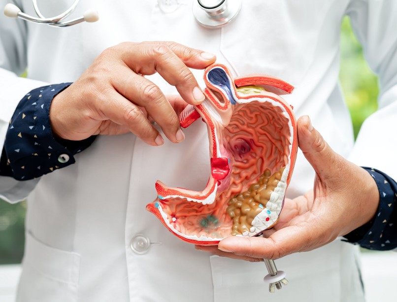 Gyomorrák melyik stádium mit jelent