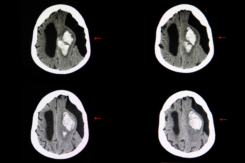 Subarachnoideális ciszta tünetei, vizsgálata és kezelése