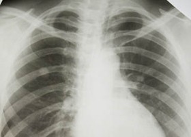 Technikai újítás: elektronikus orr a tbc felismerésére