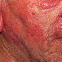 Új kezelés a piros arcbőr ellen