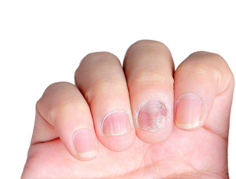 Beau vonalak kialakulása oka, tünete kezelése