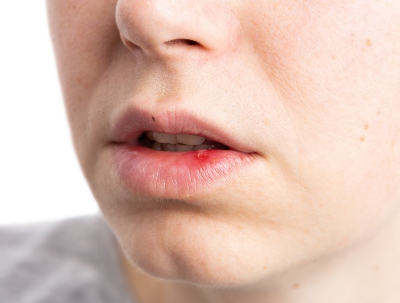 csomó dudor, hólyag, kiütés száj oka kezelése