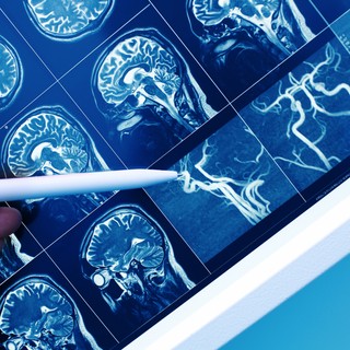 Magyar felfedezés mutathat új irányt a stroke és a demencia gyógyításában című cikk nyitóképe