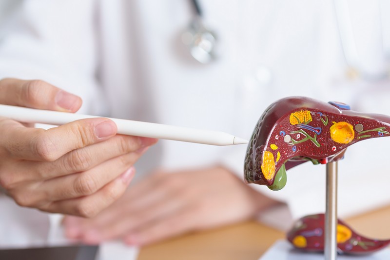 Májrák vagy májáttét? Az orvos elmagyarázza, mi a lényegi különbség