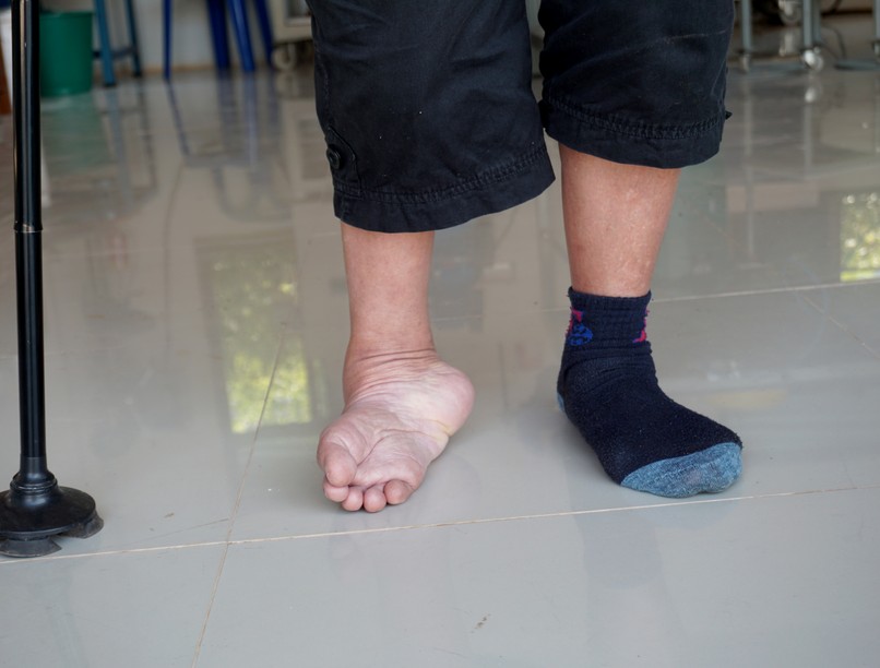 Dongaláb tünet vizsgálat kezelés