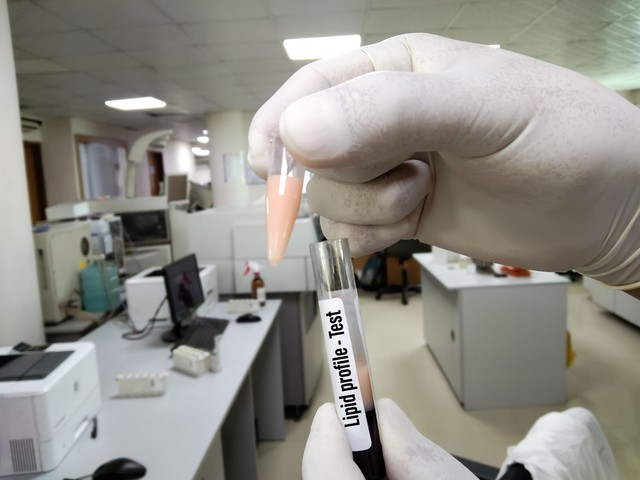 Felborult a lipidprofilja? Ezzel a 8 egyszerű lépéssel fellélegezhetnek az erei
