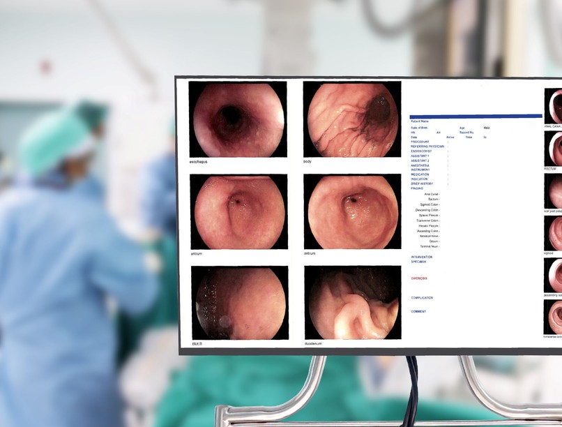 kolonoszkópia vastagbél