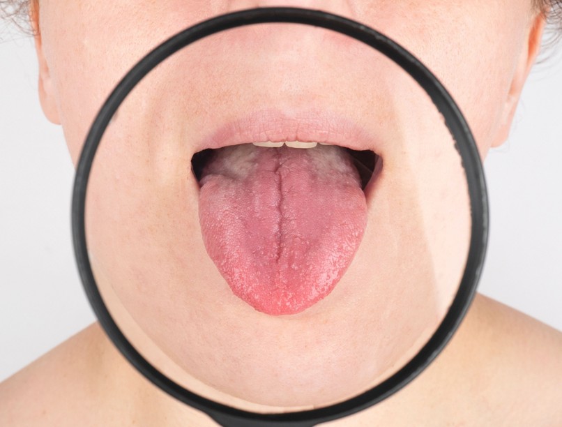 szájrák tünet afta herpesz különbség