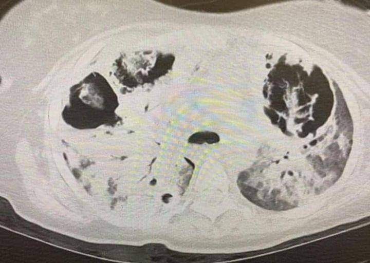 A COVID-19 fertőzés okozta tüdőgyulladás miatt a folyadékkal teli tüdő nem képes elegendő oxigént leadni a vérbe. 