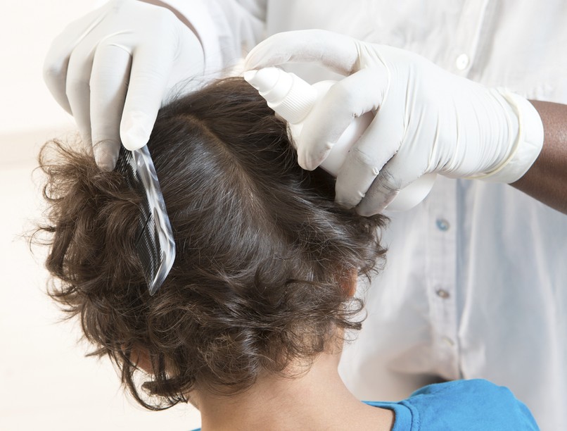 fejtetű, fertőzés oka, tünetei, kezelése, fejtetvesség, tetűírtó