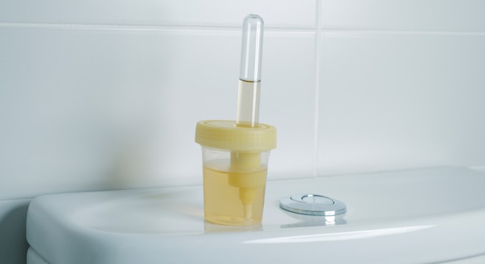 Így változik meg a széklet és a vizelet színe májbetegség esetén című cikk nyitóképe