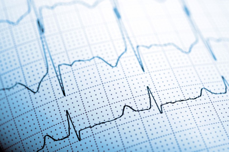 Gyorsabban olvassa az EKG-t, mint az orvosok? Egy új AI-eszköz másodpercek alatt kiszúrja a két legveszélyesebb szívbetegséget az EKG-ból